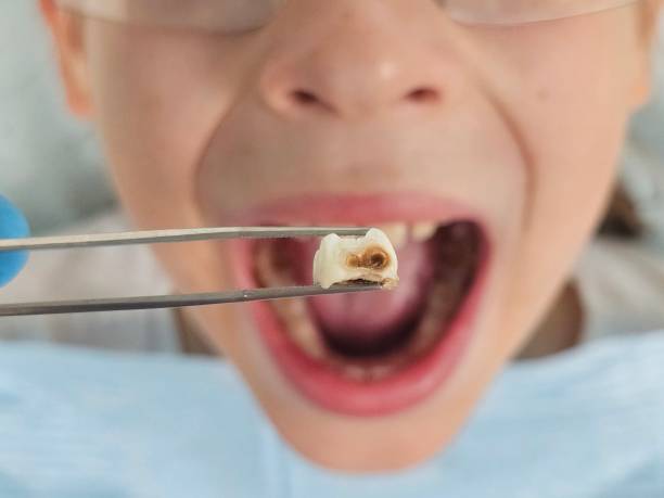 Best Broken or Chipped Tooth Repair in Littleton, CO